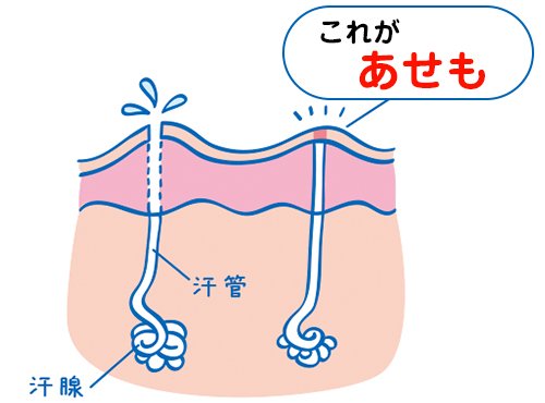 夏の一番の心配！？子どもにあせもができやすい3つの原因